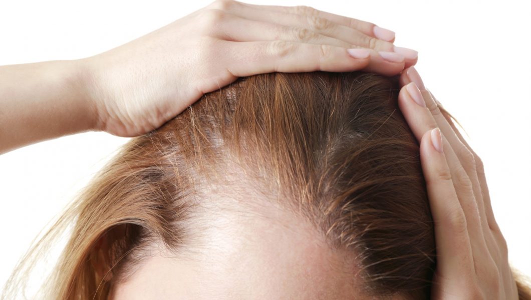 Alopecia: cand căderea părului devine o boala grava