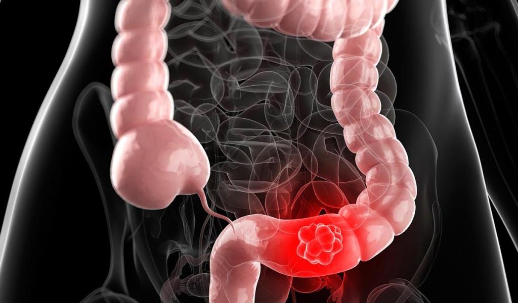Complicatiile sindromului de colon iritabil