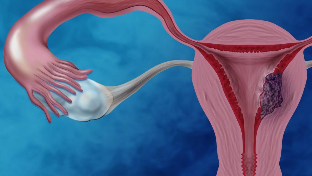 Crește post-menopauză riscul de cancer endometrial?