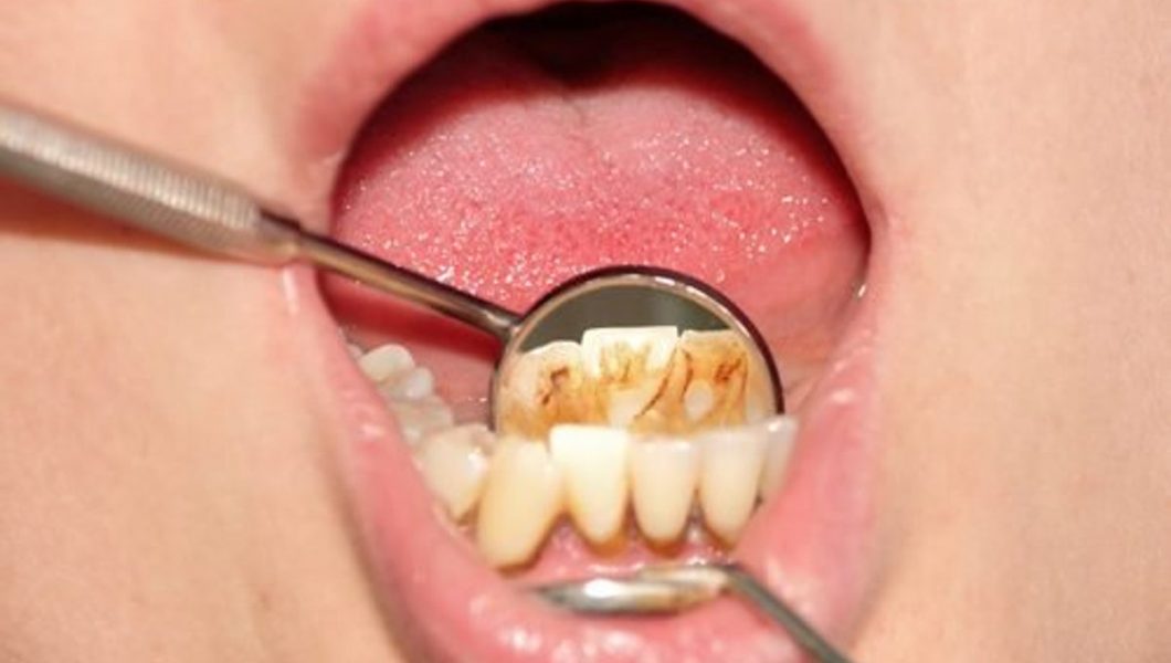 8 sfaturi pentru a elimina tartrul dentar în mod natural