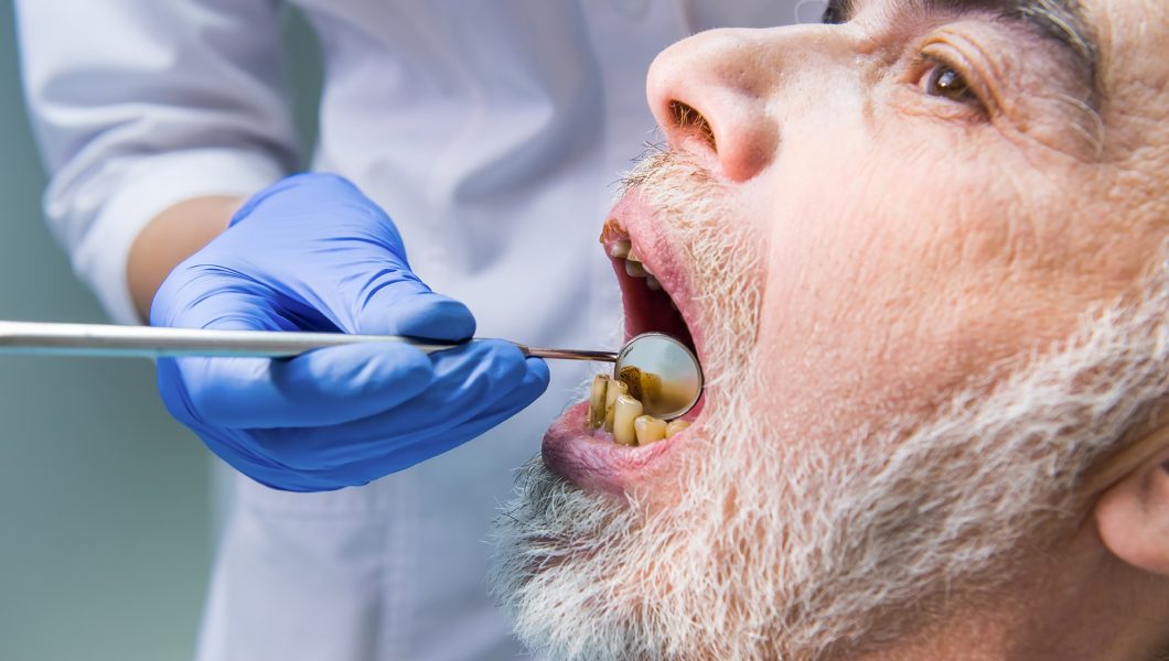 Igiena orală precara crește riscul de cancer la ficat
