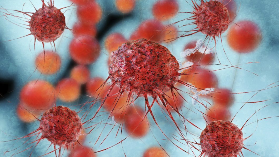 Semnele care anunta leucemia: care sunt persoanele cu risc