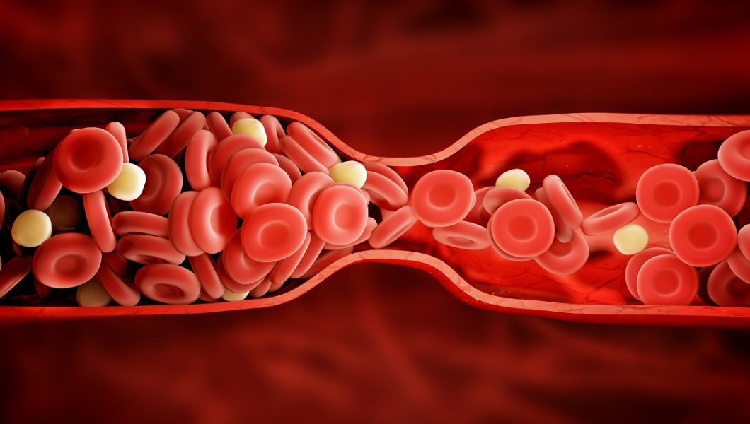 Aceste 9 simptome vă informează despre prezenta un cheag de sânge in corp