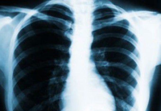 Testul online pentru depistarea cancerului pulmonar