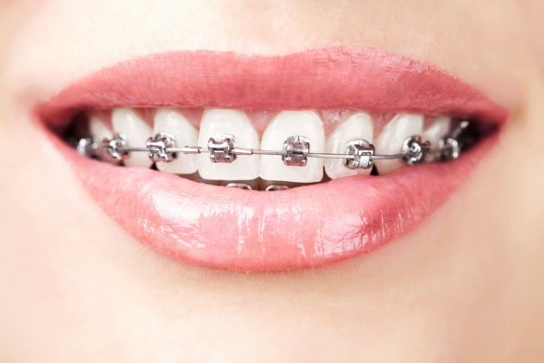 Varsta maxim pana la care sunt recomandate aparatele dentare