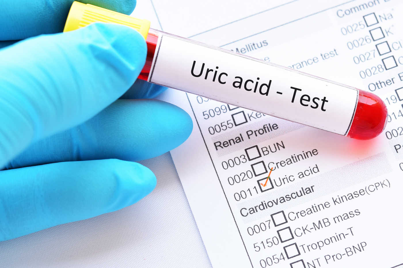 Ce factori infuenteaza nivelurile acidului uric