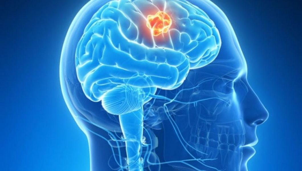 Locul in care traiesti te poate imbolnavi de cancer la creier