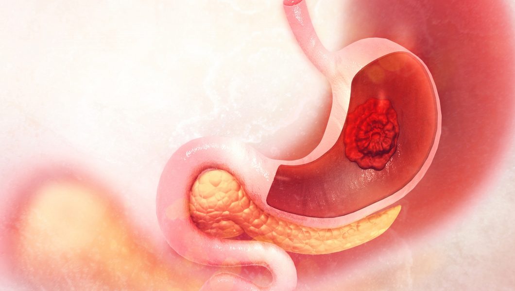 Cancerul gastric poate fi depistat in faza incipienta cu aceasta investigatie