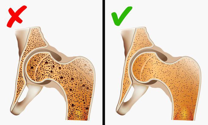 Ce trebuie sa faci ca sa previi osteoporoza