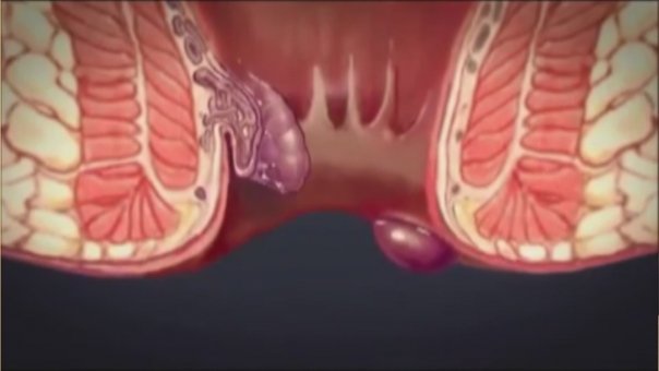 Cum se trateaza hemoroizii aparuti in perioada de sarcina