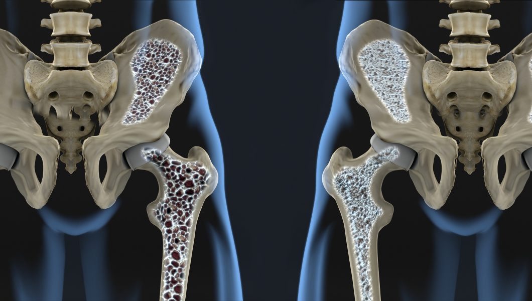 Riscul de osteoporoza si seleniul. Ce legatura exista