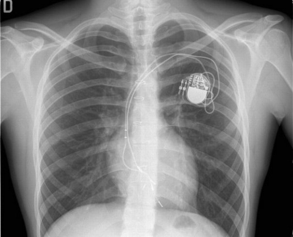 Cum pot influenta dispozitivele electronice functionarea unui pacemaker