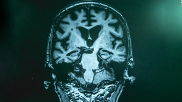 O noua boala este confundata adesea cu Alzheimerul