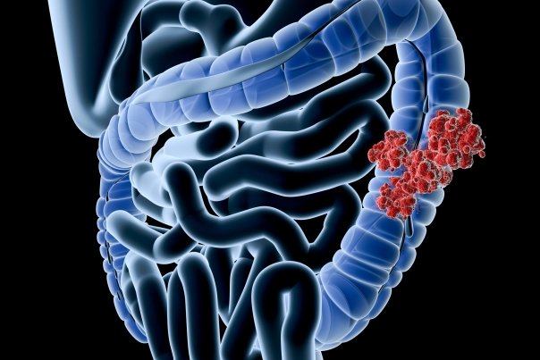 Simptomele cancerului de colon pe care le trecem cu vederea