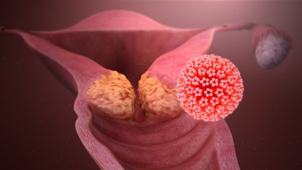 Neadevaruri despre virusul HPV si infectarea cu acesta