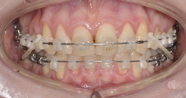 Ce este important de stiut atunci cand mergi la medicul ortodont pentru prima data