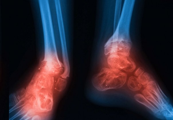 Ce este osteomielita si cum se trateaza