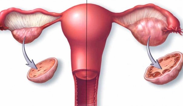 Simptomele si tratamentul chisturilor ovariene