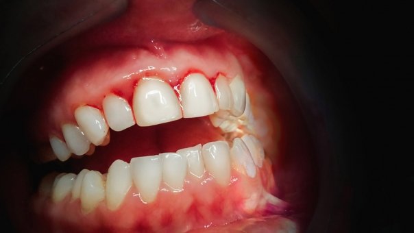 Cum se previne parodontoza in mod natural