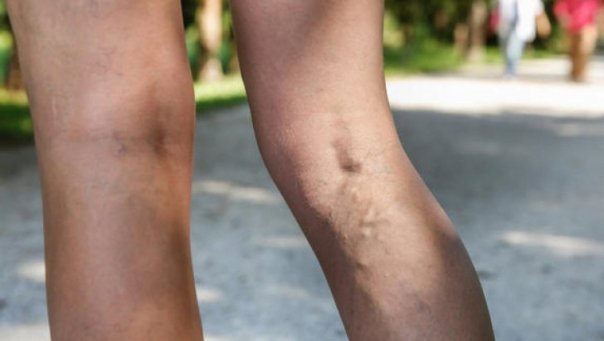 Expunerea la soare poate agrava varicele si venele sparte de pe picioare