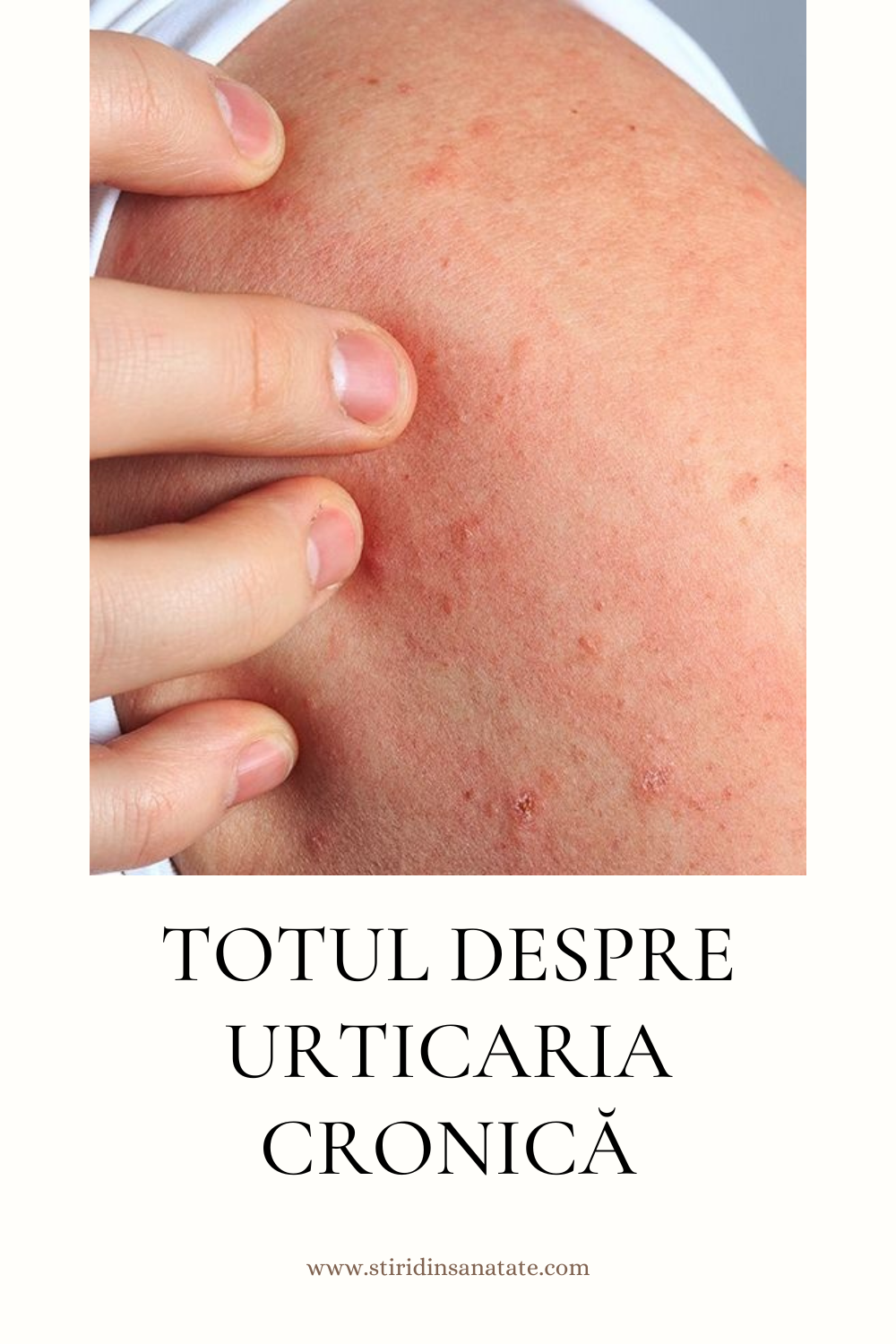 urticaria cronica