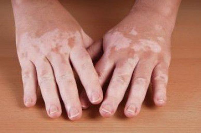 Cum apare si cum trebuie sa ne ingrijim atunci cand suferim de Vitiligo