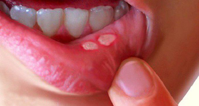 Ulcer bucal si afte? Remediile astea naturiste te scapa imediat de problema