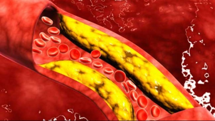 Nivelul colesterolului trebuie verificat inainte de implinirea varstei de 45 ani